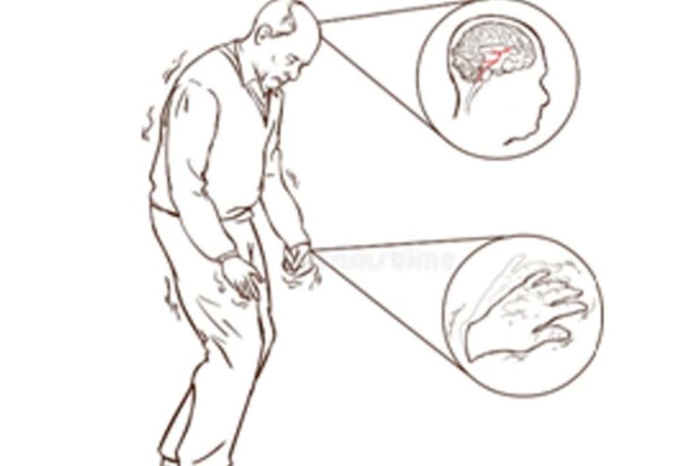 Tes Darah Teknologi AI Bisa Prediksi Gejala Penyakit Parkinson 7 tahun Sebelum Terjadi