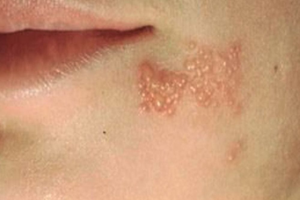 Kenali Penyebab dan Cara Mencegah Herpes Zoster