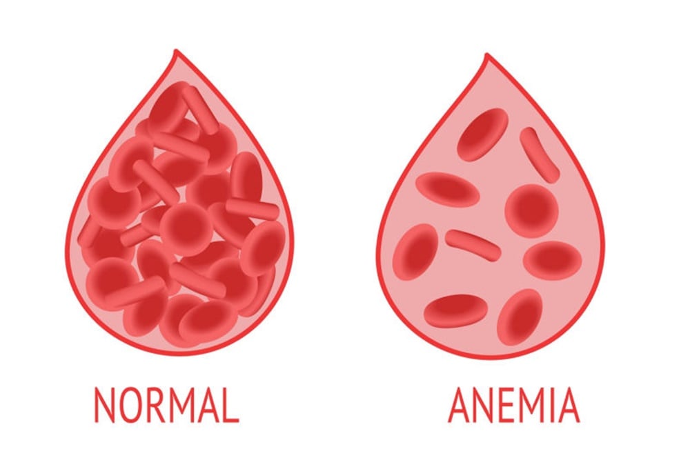 Cegah Anemia, Bisa Turunkan Angka Kematian Ibu