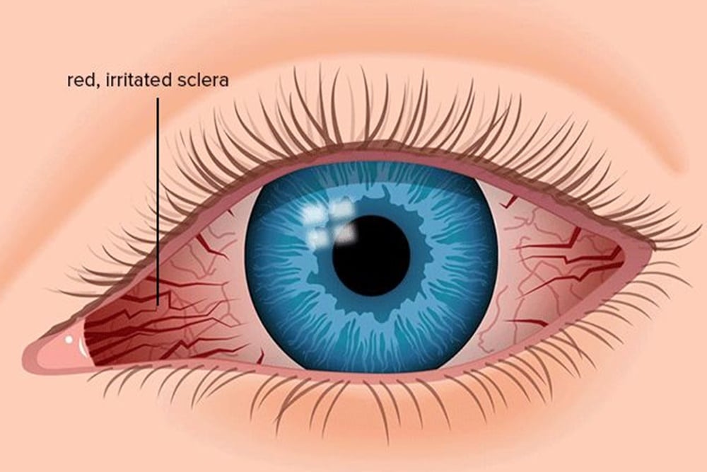 Menggosok Mata Berlebihan Bisa Bikin Infeksi hingga Kerusakan Retina