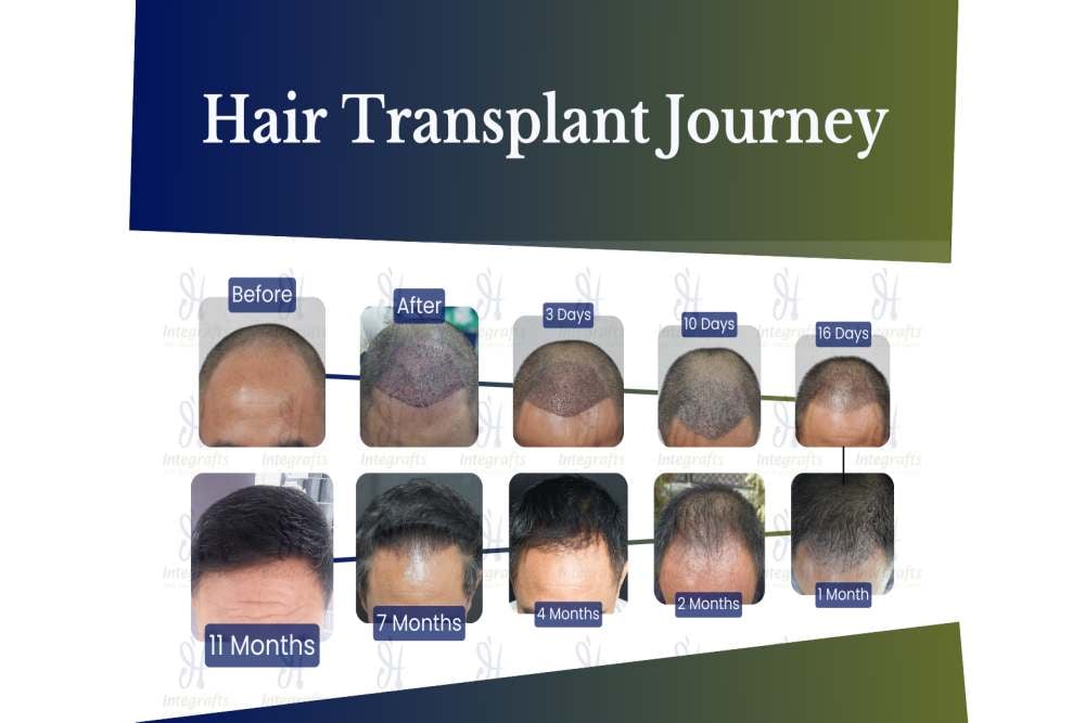 Berapa Biaya Transplantasi Rambut yang Kini Sedang Tren?